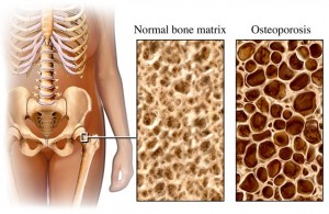 osteoporosis